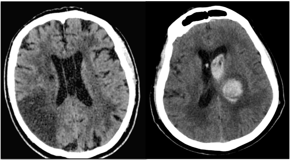 Accidentul Vascular Cerebral