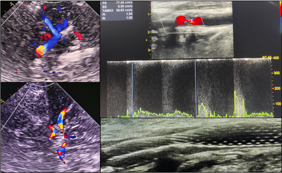 Ecografia Doppler de vase cervicale. Ecografia Doppler transcraniană.