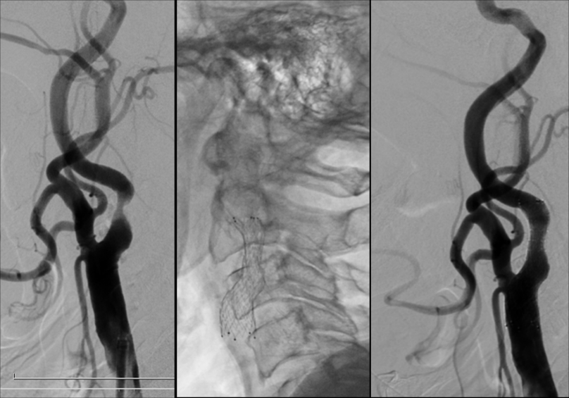 Stenting carotidian