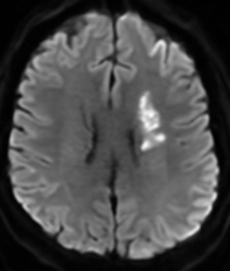 AVC ischemic